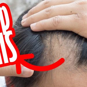 Why Is My Hair Falling Out? - How To STOP HAIR LOSS - Dr. Goutham Kumar