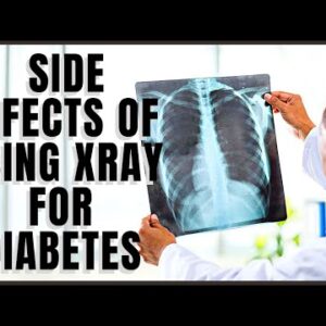 The Side Effects of Using Xray for Diabetes