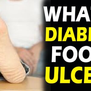 What Is Diabetic Foot Ulcer | DR Krishna Mohan | Free Diabetes