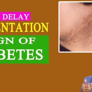 Is Pigmentation a sign of diabetes? | Free Diabetes