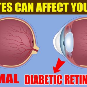 What You Need to Know Diabetes and Your Eyes | Free Diabetes