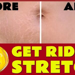 Remove Stretch Marks Completely from all body Parts -Home remedy | Free Diabetes