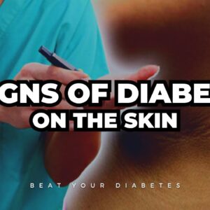 The 5 Signs of Diabetes on the Skin, New Studies