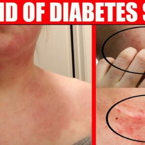 Doctor explains SKIN CONDITIONS associated with DIABETES | Free Diabetes