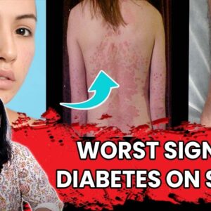 WHAT DIABETES DOES TO YOUR SKIN |Top Signs of Diabetes on The Skin! With Cosmologist | Free Diabetes