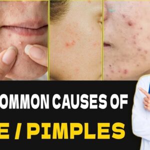 Most Common Causes & FASTEST Way To Get Rid Of PIMPLES / ACNE | #skincare #skincareroutine