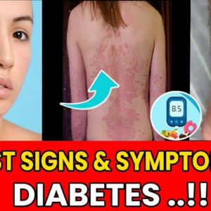 Diabetic Skin Problems & Top Signs of Diabetes on The Skin! | #curediabetes | @FreeDiabetes