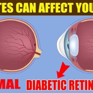 DIABETIC RETINOPATHY - What You Need to Know About Diabetes and Your Eyes | Free Diabetes