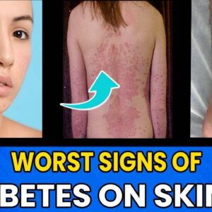 Diabetic Skin Problems & Top Signs of Diabetes on The Skin! | What Happens To Skin Due To Diabetes